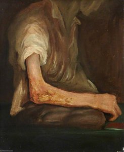 The Wounded Following The Battle Of Corunna Musket Ball Wound Of Elbow — Charles Bell