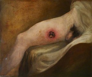 The Wounded Following The Battle Of Corunna Gunshot Wound Of Thigh — Charles Bell