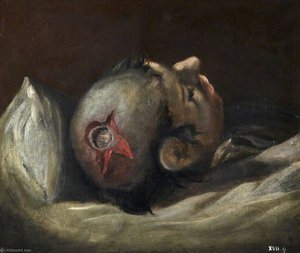 The Wounded Following The Battle Of Corunna Musket Ball Wound Of Skull — Charles Bell